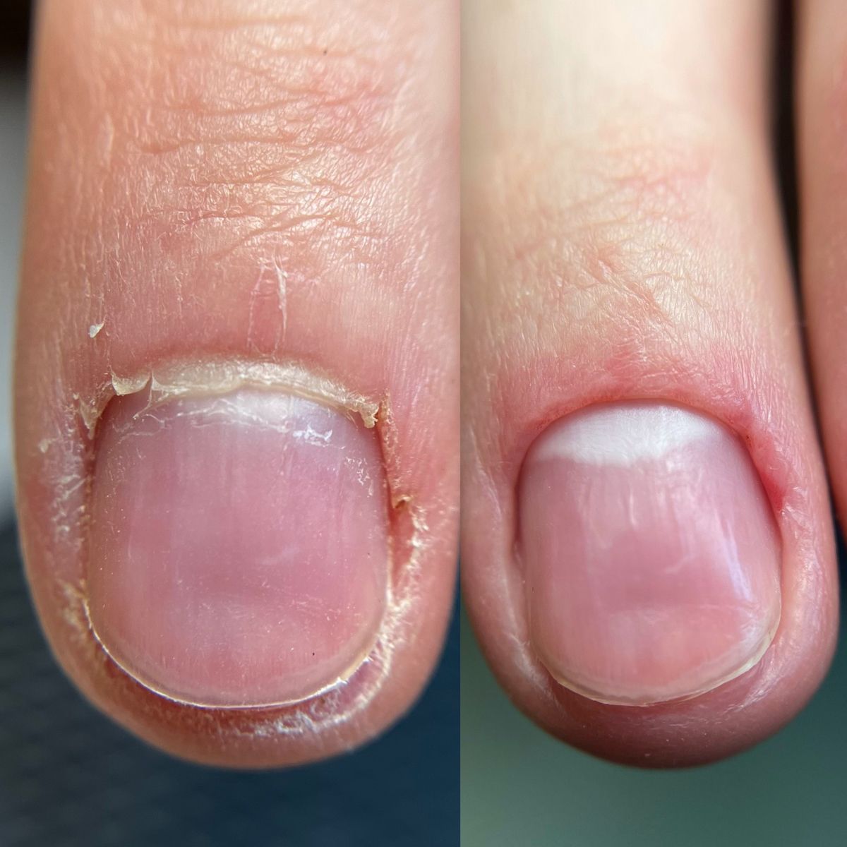 peeling gel polish damaging natural nails